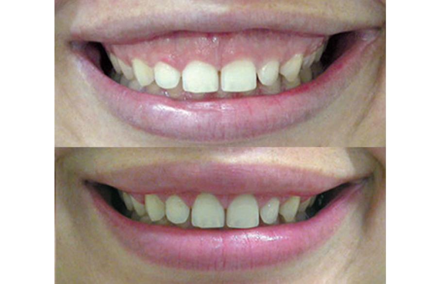 Tratamento multidisciplinar: Estética, toxina botulínica e periodontia.