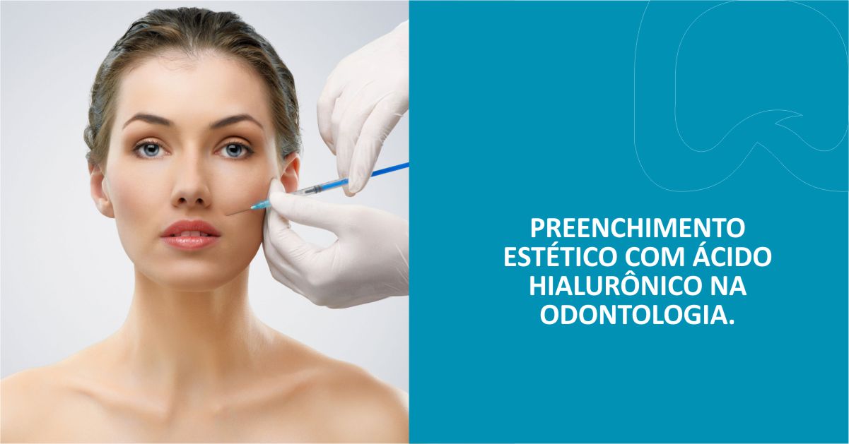 Preenchimento Estético com Ácido Hialurônico na Odontologia