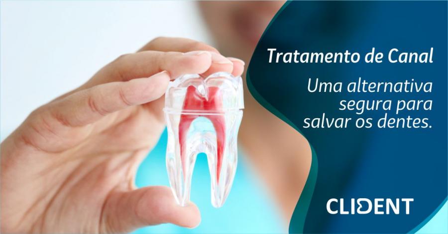 Tratamento de Canal – Uma Alternativa Segura Para Salvar Os Dentes